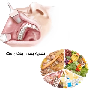 تغذیه بعد از بوکال فت