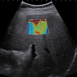 سیستم  Liver Fibrosis Assessment