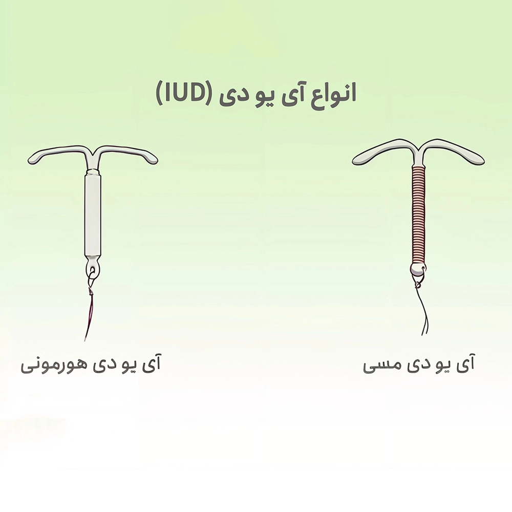 ای یو دی مسی بهتر است یا هورمونی