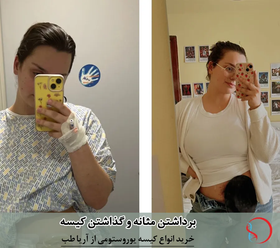 برداشتن مثانه و گذاشتن کیسه