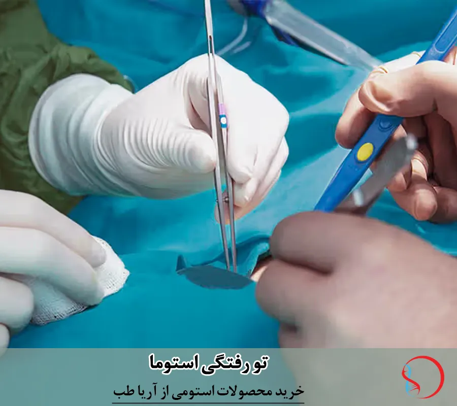 تو رفتگی استوما