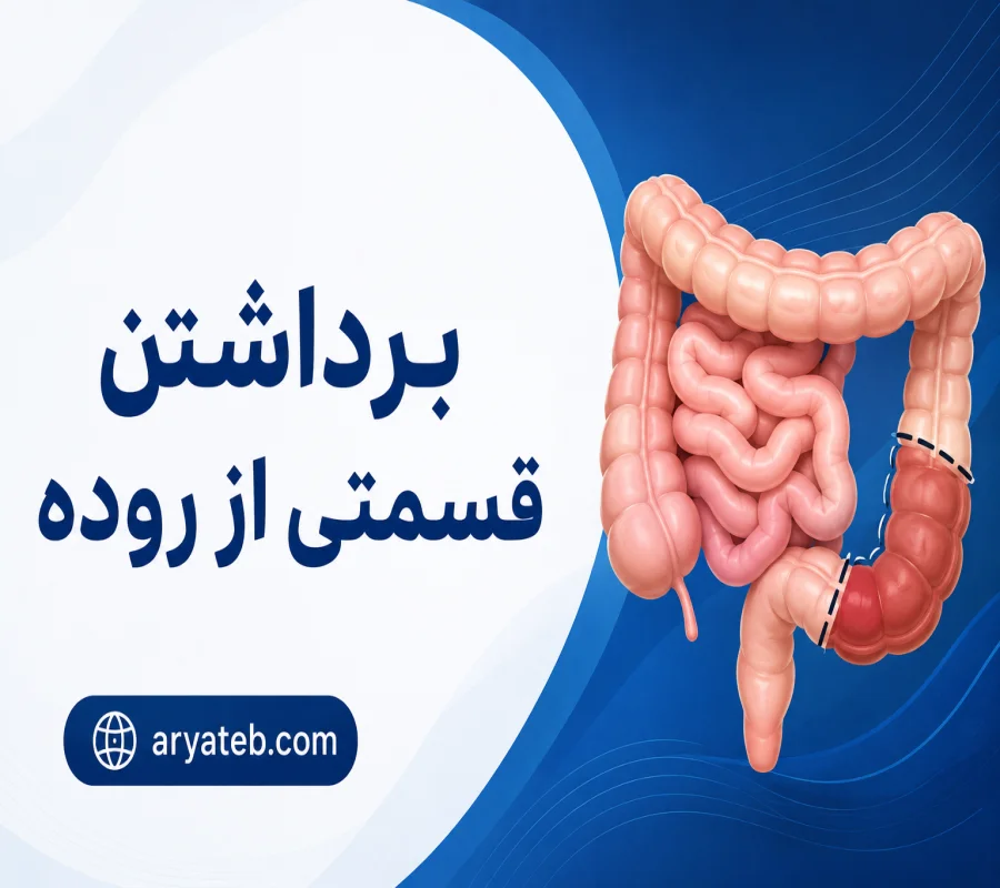 برداشتن قسمتی از روده