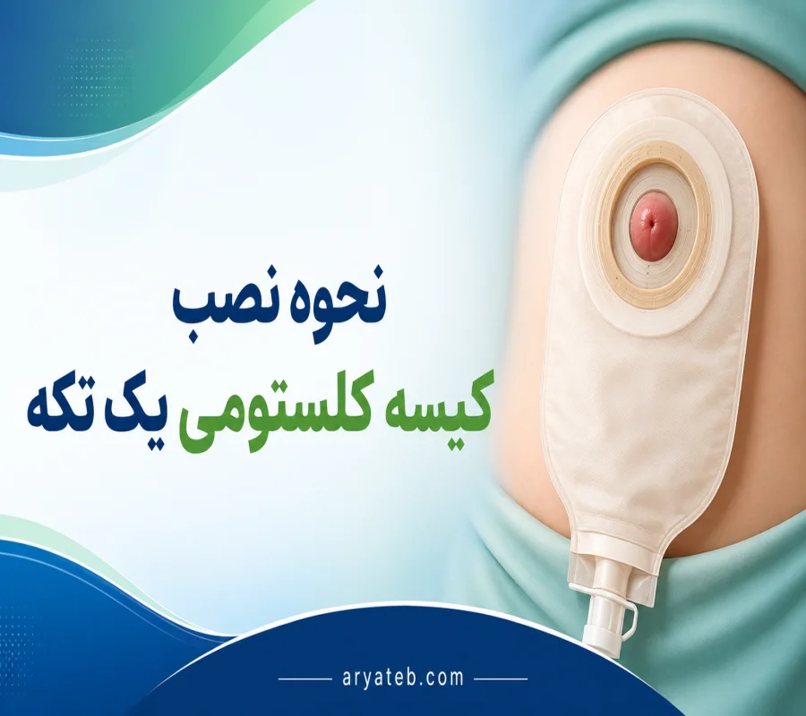 نحوه نصب کیسه کلستومی یک تکه