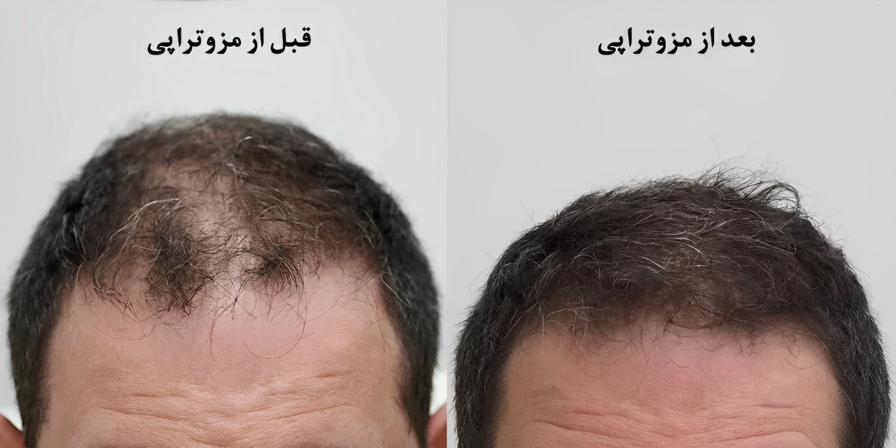  انواع دستگاه‌های مزوتراپی مو