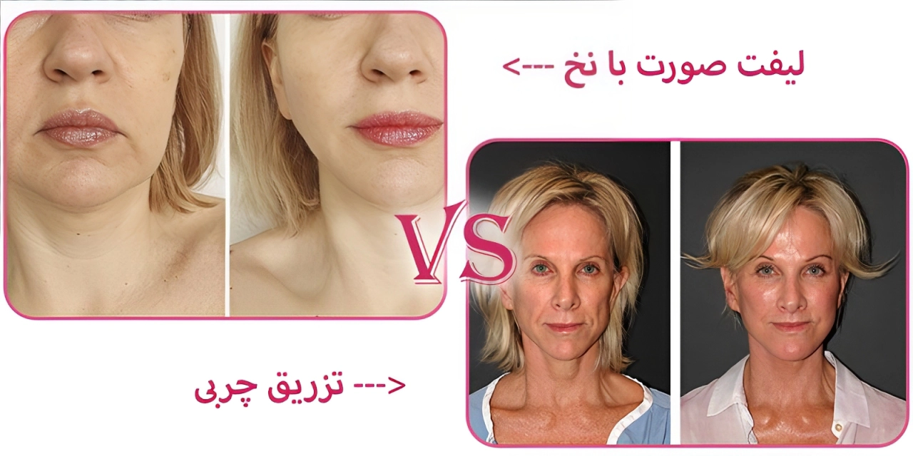 لیفت صورت با نخ بهتر است یا تزریق چربی