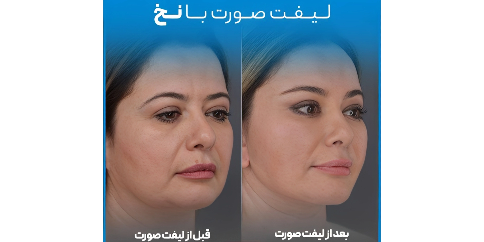 لیفت صورت با نخ برای چه سنی مناسب است