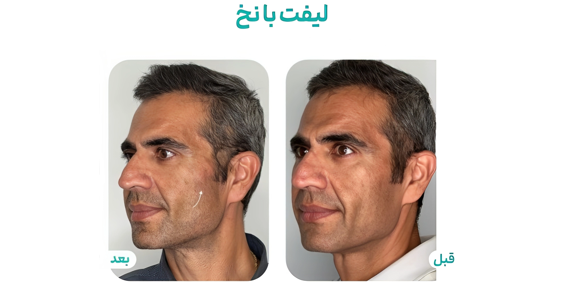 لیفت صورت با نخ بهتر است یا تزریق چربی