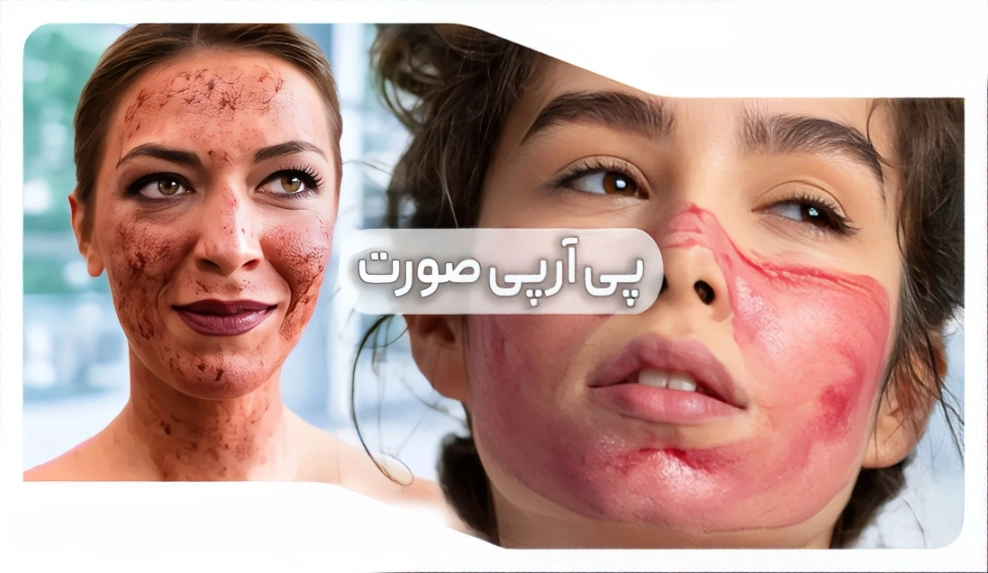عکس قبل و بعد از پی آر پی صورت