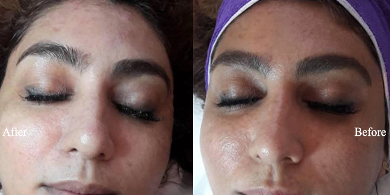 عکس قبل و بعد پلاژن تراپی