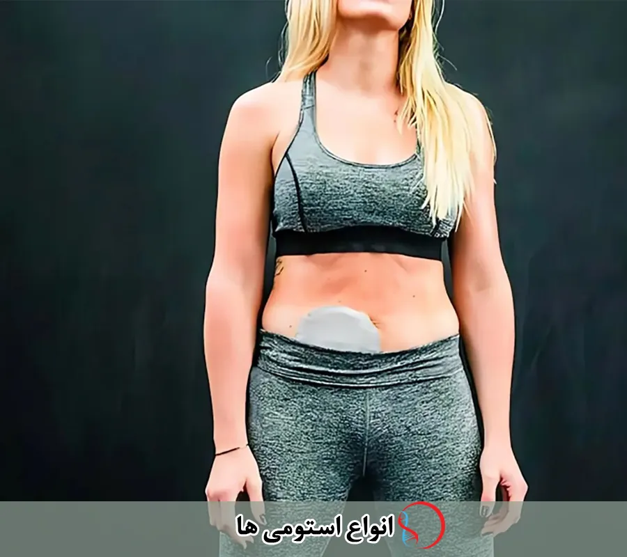 بررسی انواع استومی