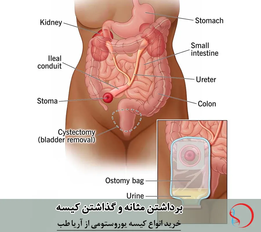 آمادگی برای عمل برداشتن مثانه