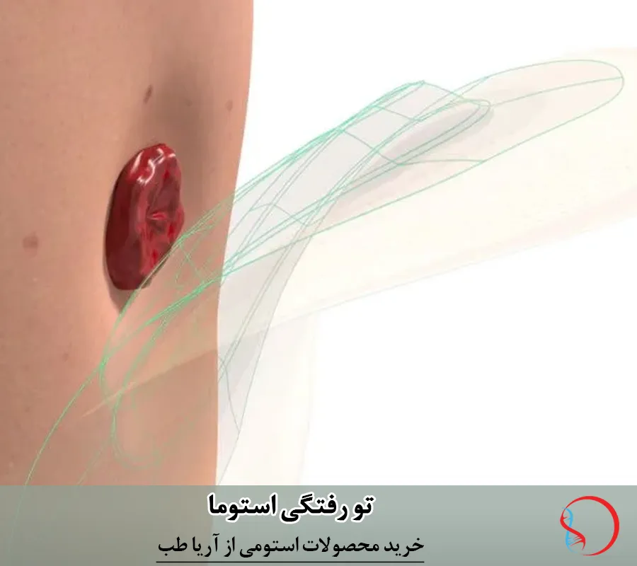 مدیریت تو رفتگی (Retraction) استوما