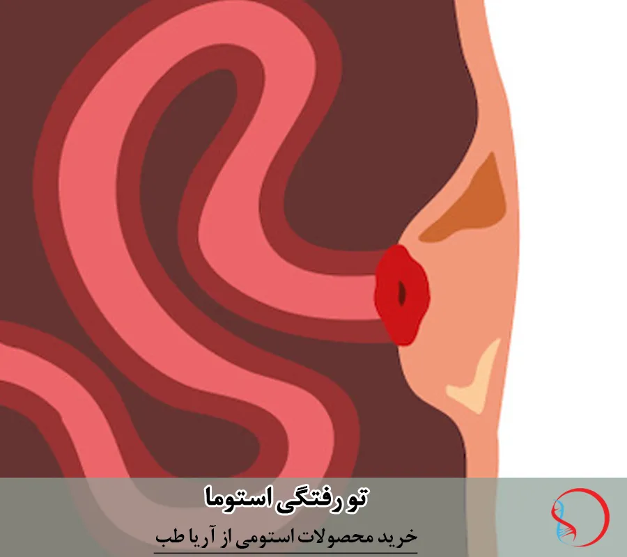 دلایل تو رفتگی استوما
