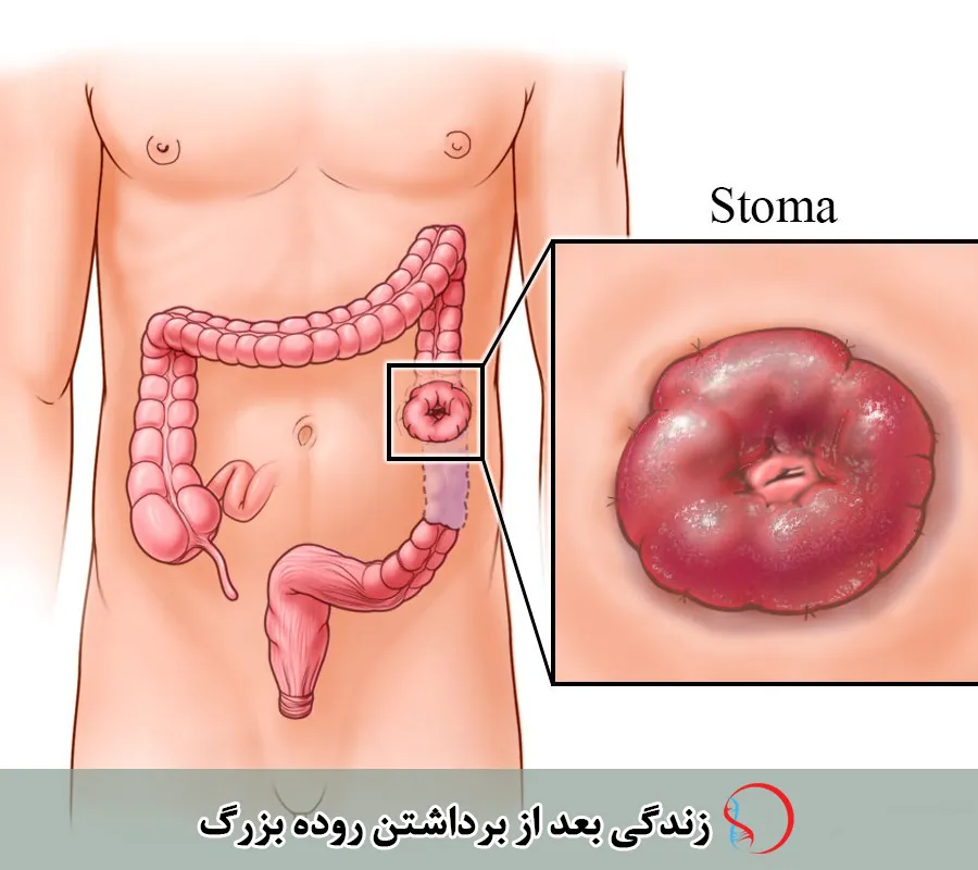 بهبودی پس از جراحی روده بزرگ
