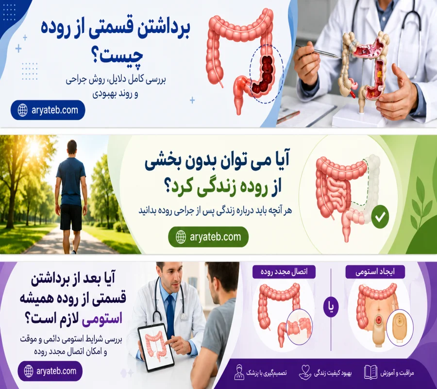 برداشتن روده