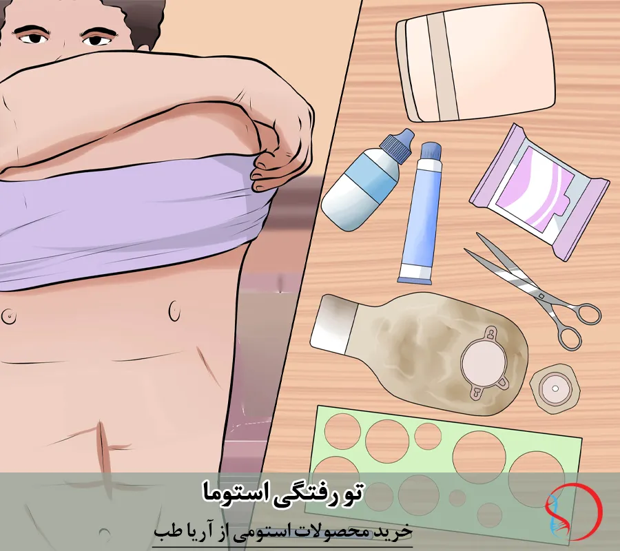 تعویض کیسه استومی