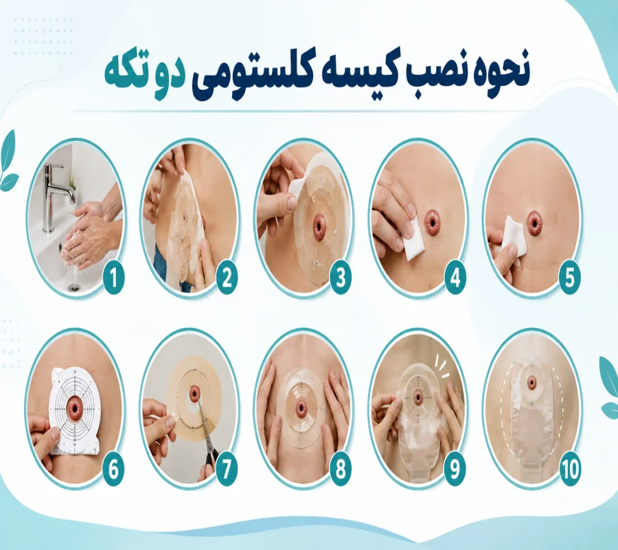نحوه نصب کلستومی دو تکه