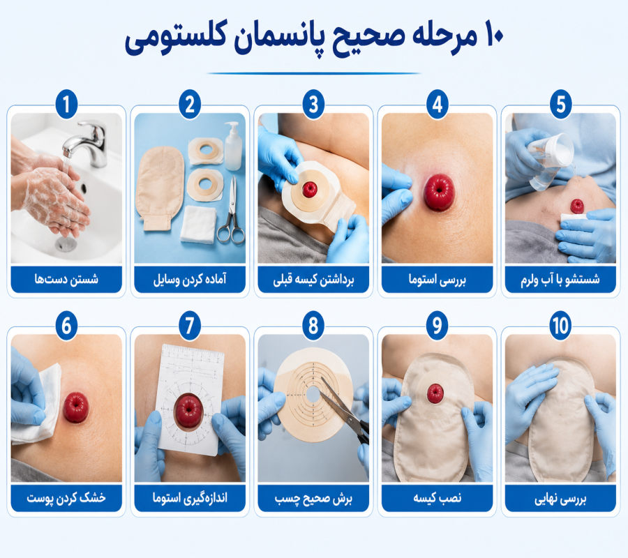10 مرحله صحیح پانسمان کلستومی