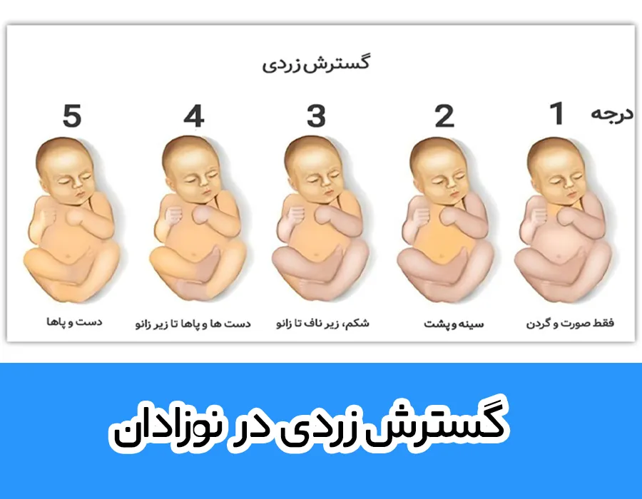 جدول زردی نوزاد