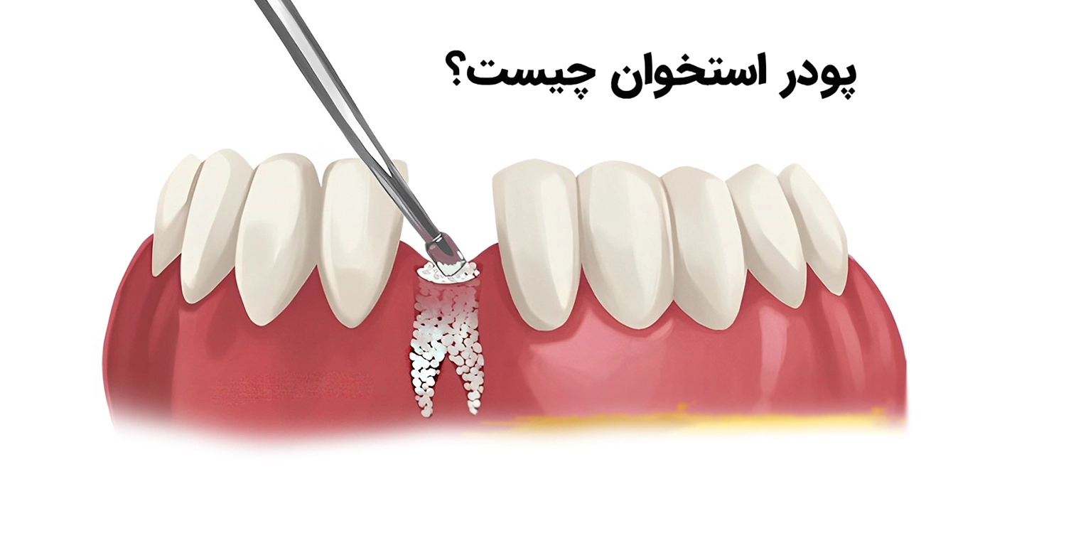 کاربرد پودر استخوان دردندانپزشکی
