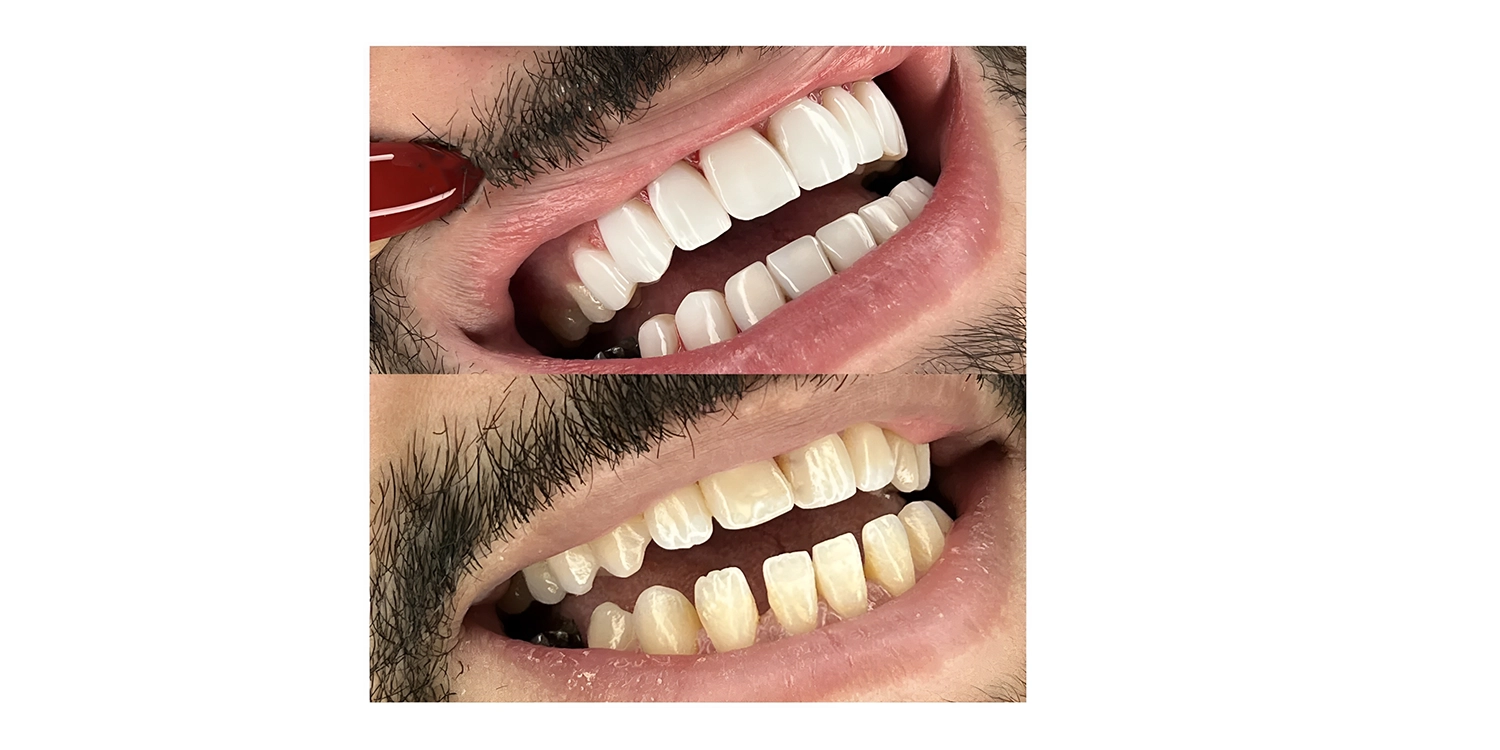 کامپوزیت ips کجایی است؟ 
