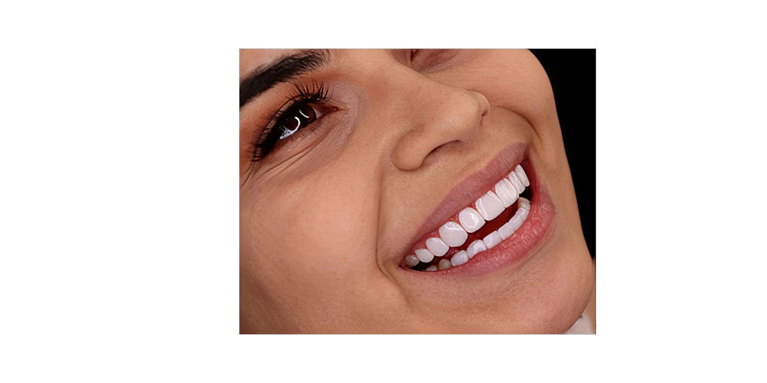 نمونه کار کامپوزیت کاریزما 