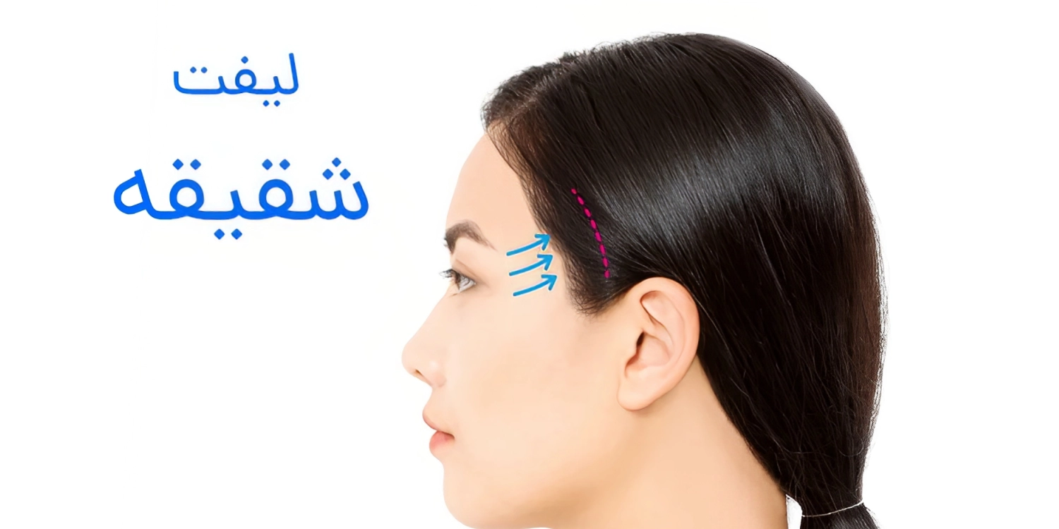 گن لیفت شقیقه
