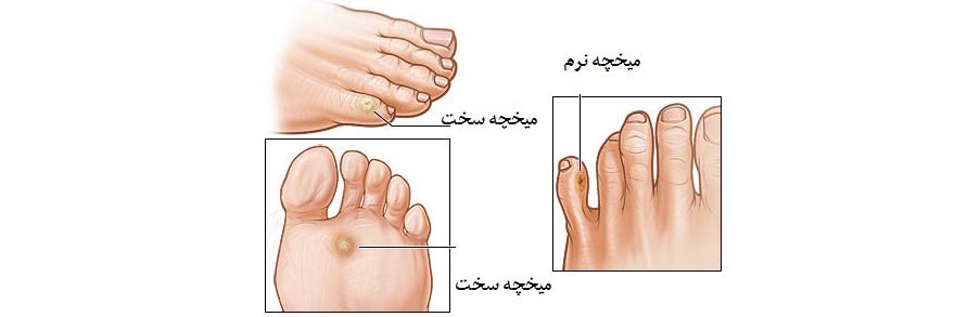 چسب میخچه