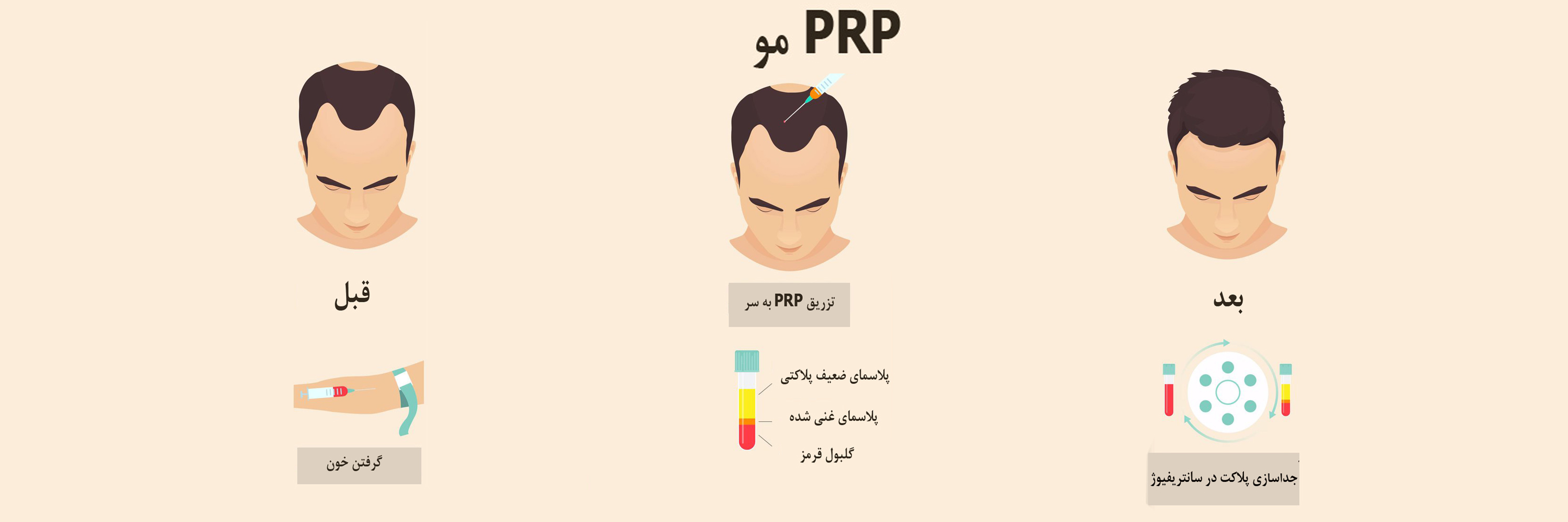 کیت prp