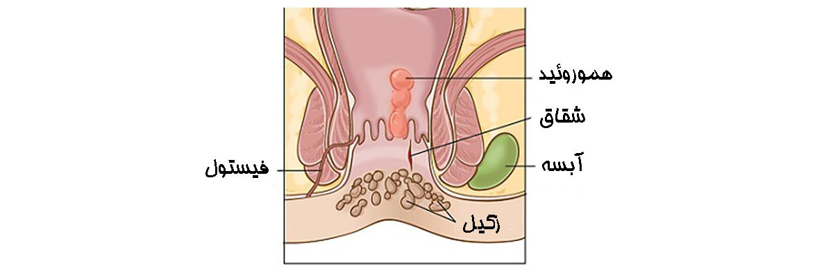 اسپکلوم مقعد