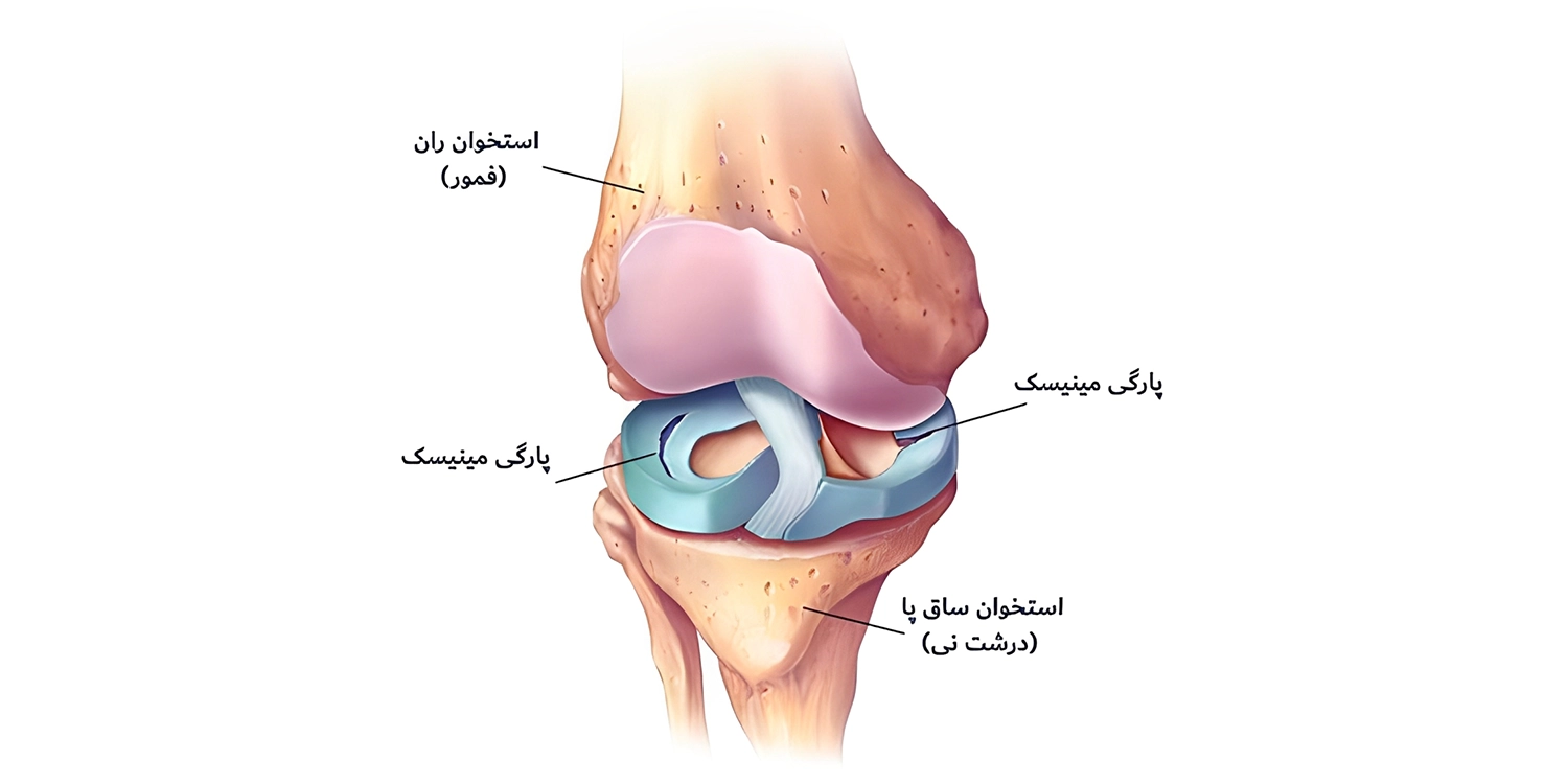 زانو بند طبی برای پارگی مینیسک