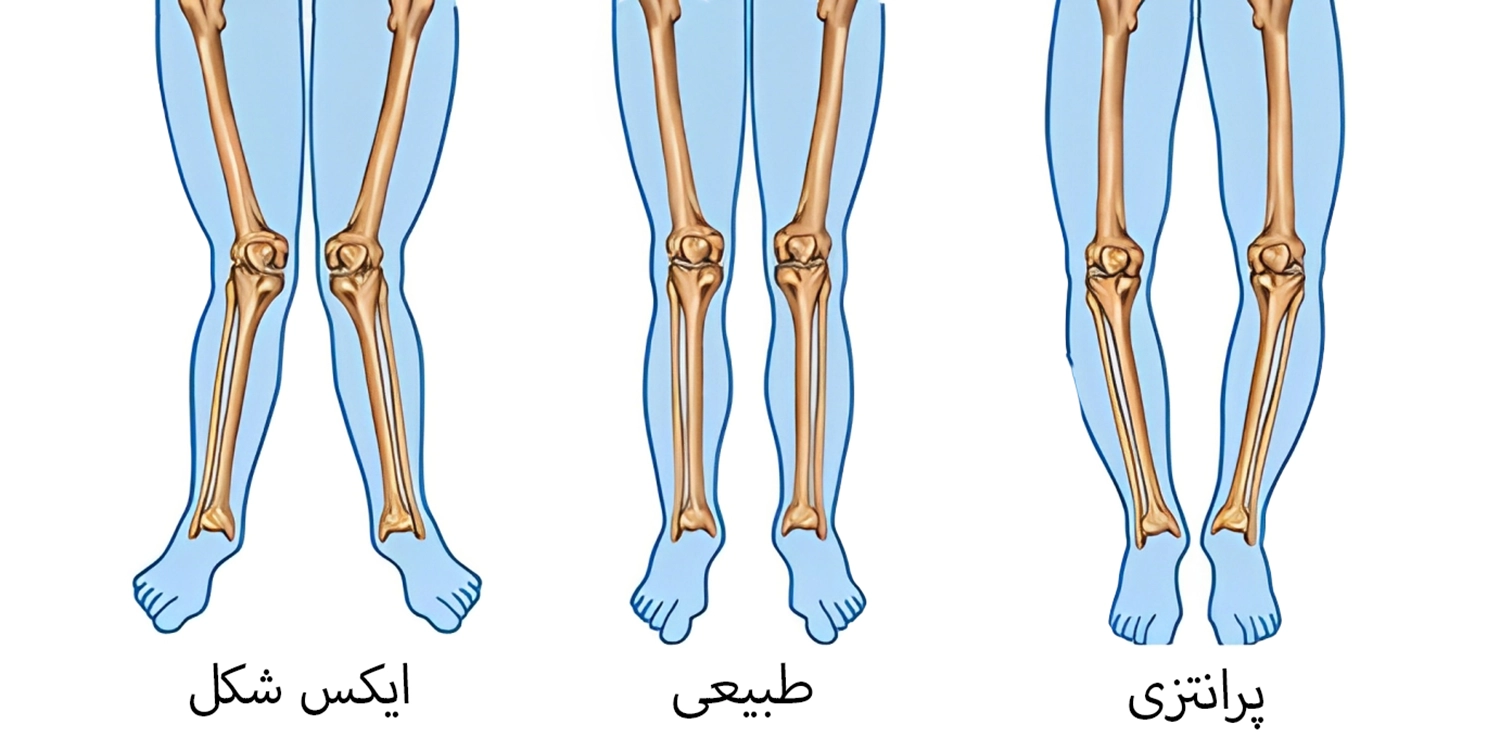 زانو بند طبی برای پای پرانتزی