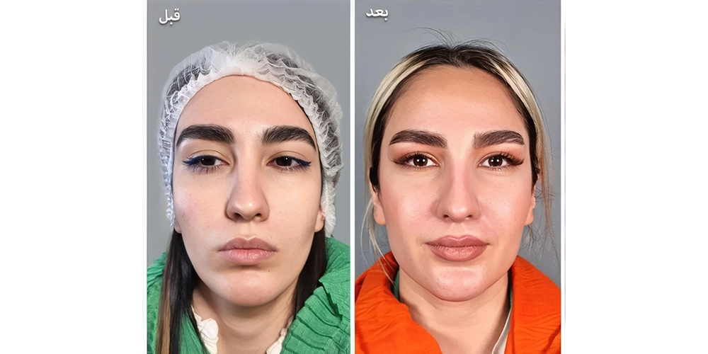 فیلر گونه
