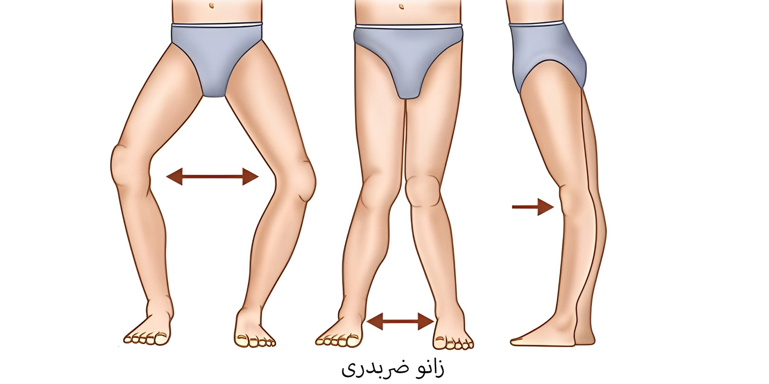 زانو بند طبی برای پای ضربدری