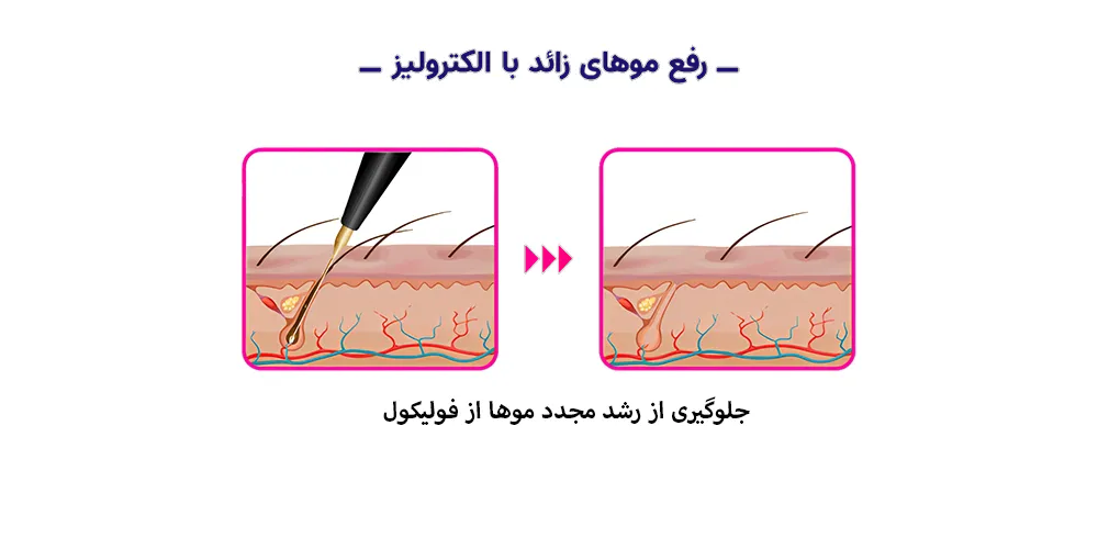  دستگاه الکترولیز موهای زائد چیست