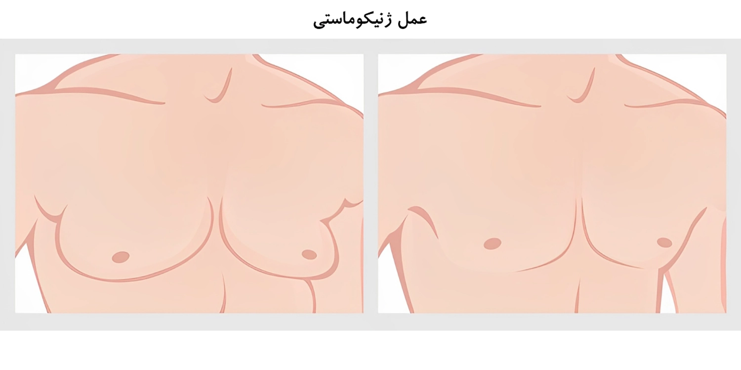 نحوه خوابیدن بعد از عمل ژنیکوماستی