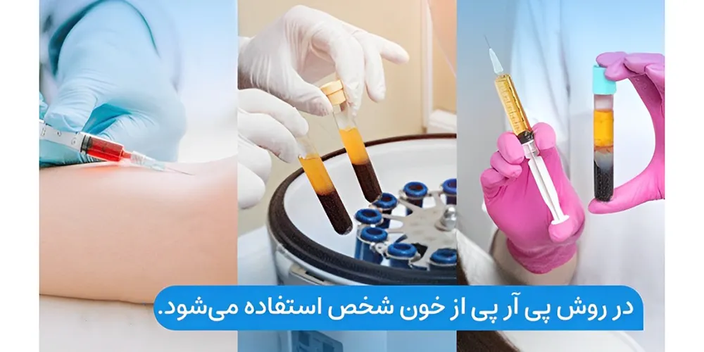 روش جدید کاشت مو با تزریق خون