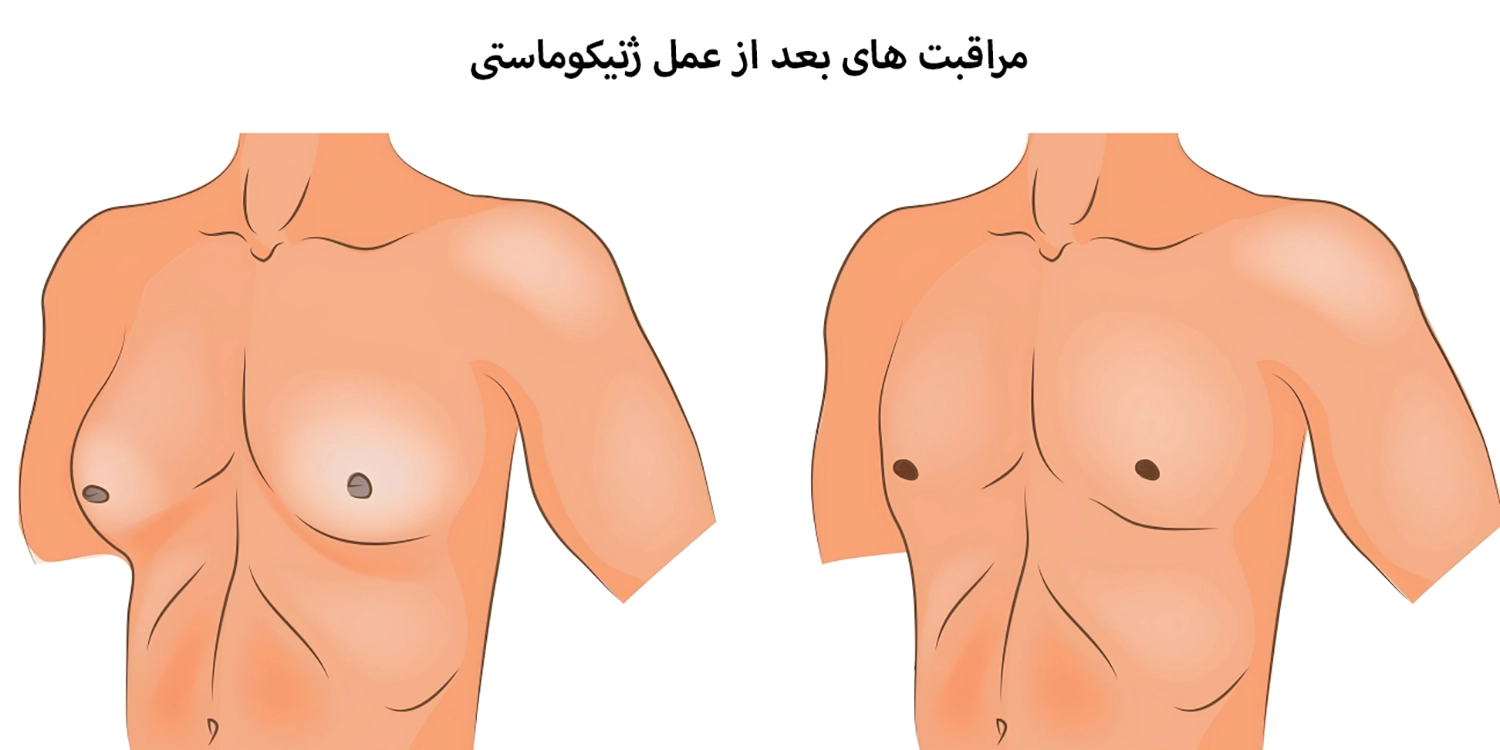 مراقبت های بعد از عمل ژنیکوماستی