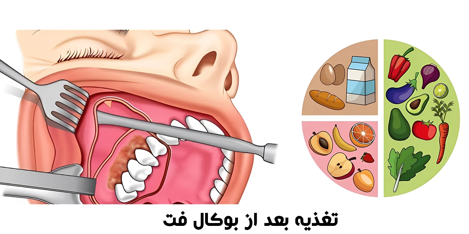 تغذیه بعد از بوکال فت