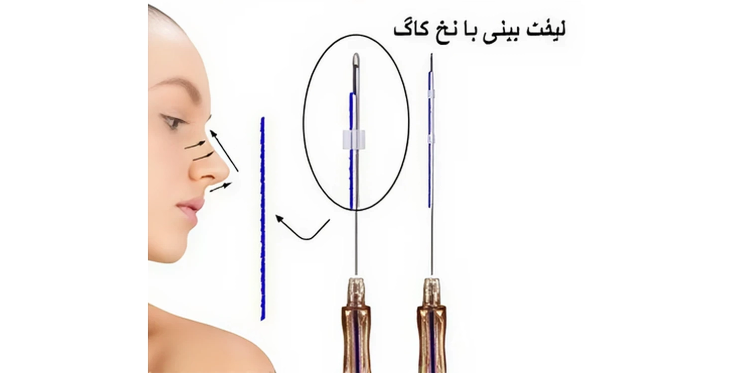نخ لیفت بینی مدیلیفت