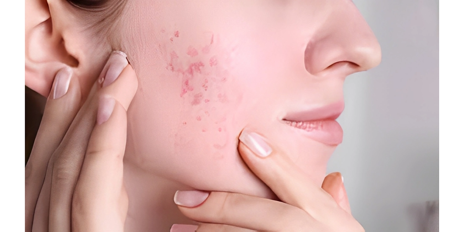 روش استفاده از کرم اسکار استاتیک