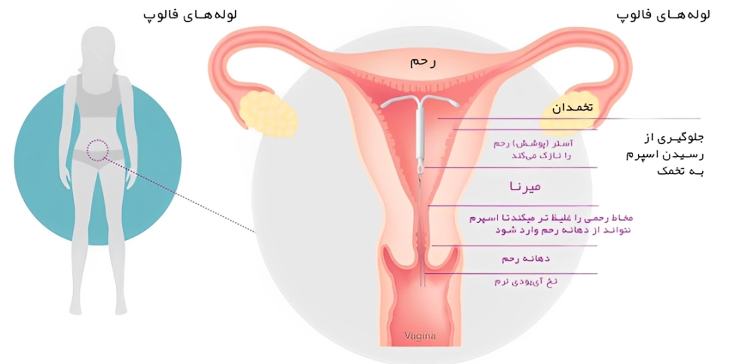 آیودی میرنا برای آندومتریوز