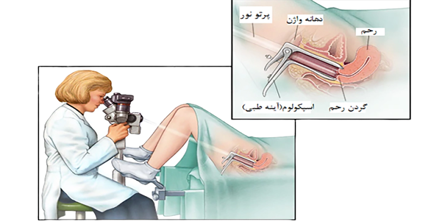 اسپکولوم واژینال چیست